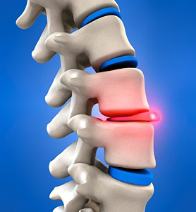 San Diego Spinal Decompression Treatment