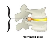 San Diego Herniated Disc Treatment