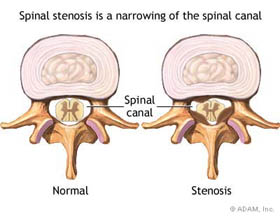 Spinal Stenosis Treatment