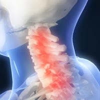 Neck Pain Treatment San Diego